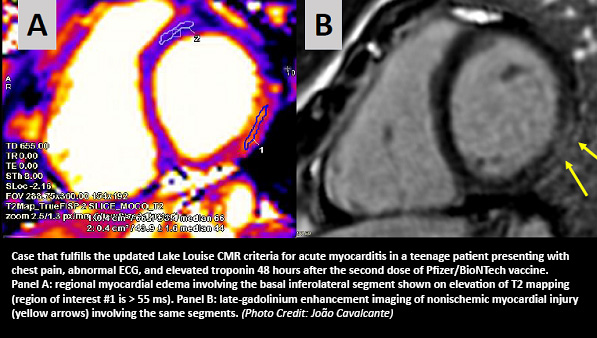 More Evidence Links Myocarditis to mRNA COVID 19 Vaccines tctmd